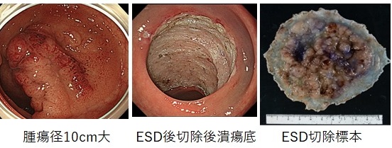 早期直腸がんに対するESD2