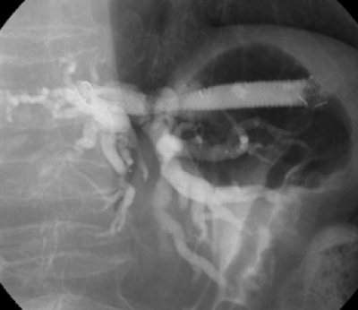 超音波内視鏡下胆道ドレナージ01_202604
